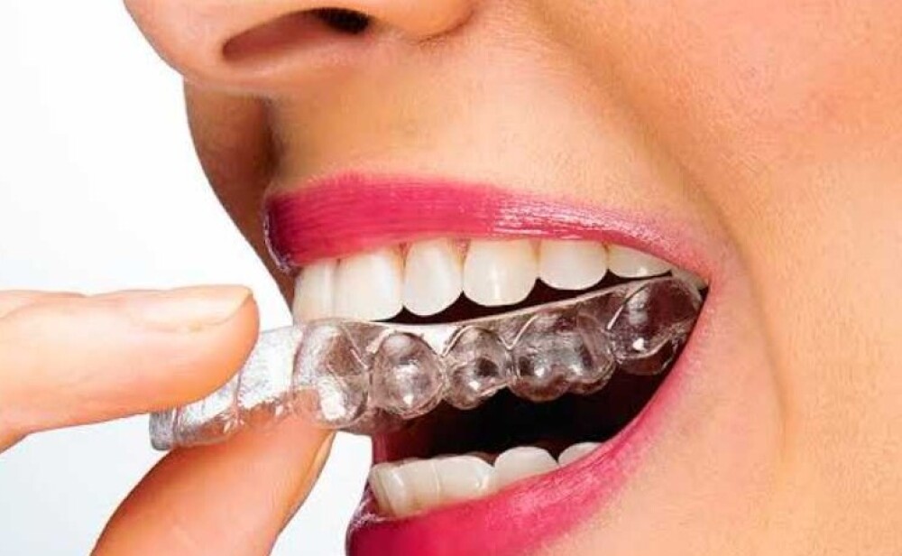 Clear Aligners